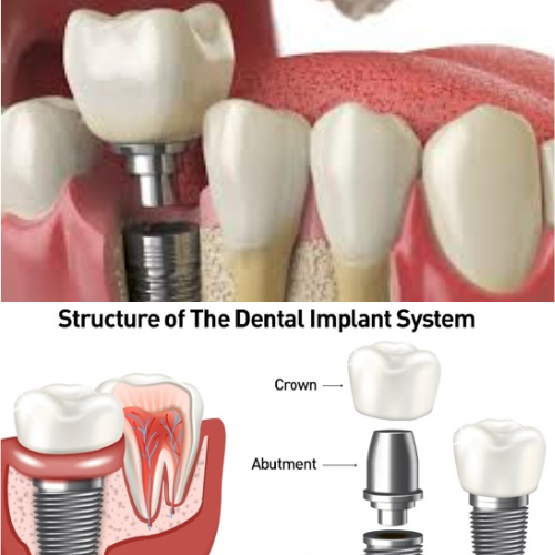 Dental Implants