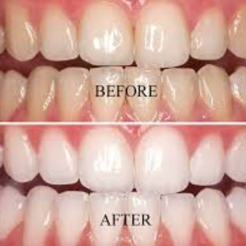 teeth whitening